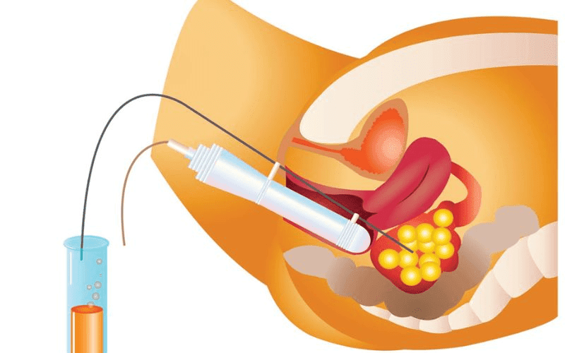 Quá trình chuyển phôi diễn ra như thế nào?